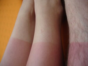 turmeric and sunburn pain